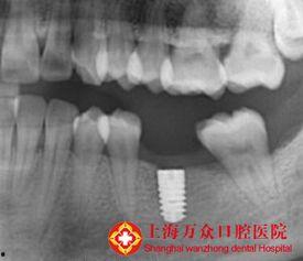 国产种牙失败案例视频讲解,揭秘种植牙风险与选择要点