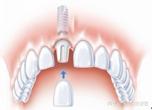 国产种牙失败案例视频讲解,揭秘种植牙风险与选择要点